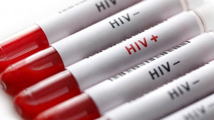 Xét nghiệm HIV âm tính là gì? Xét nghiệm HIV dương tính là gì?
